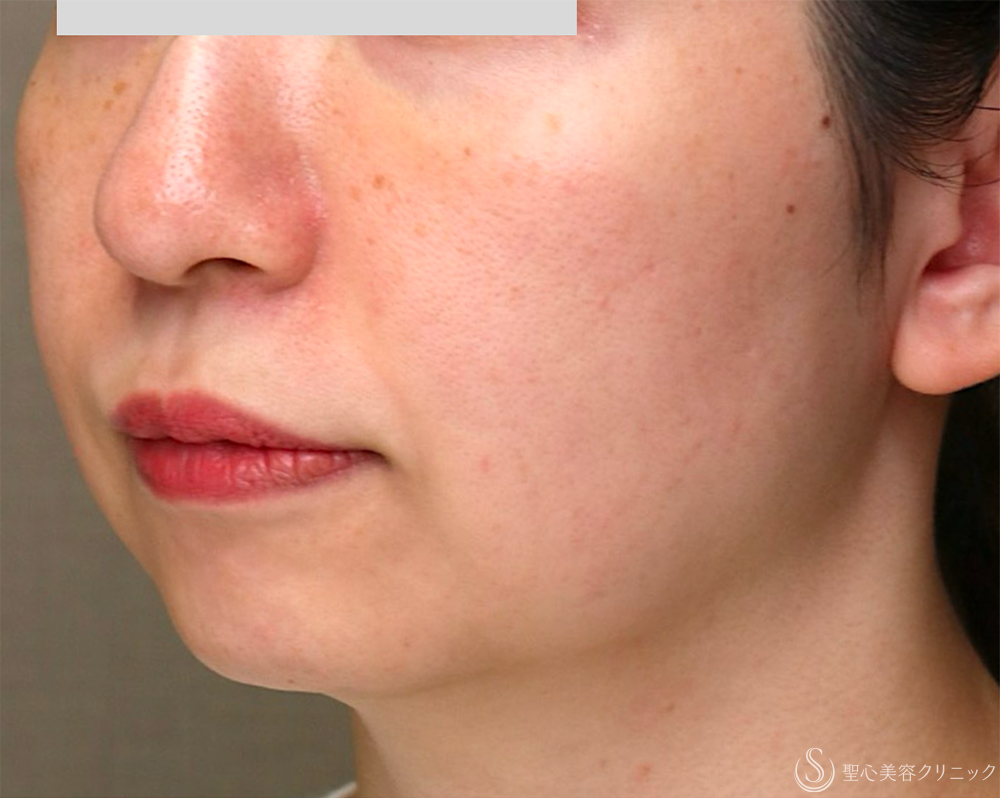 【30代女性・お顔の「筋トレ」でリフトアップ】【顔筋ケア】ワンダーフェイスプロ（3回施術直後） Before 