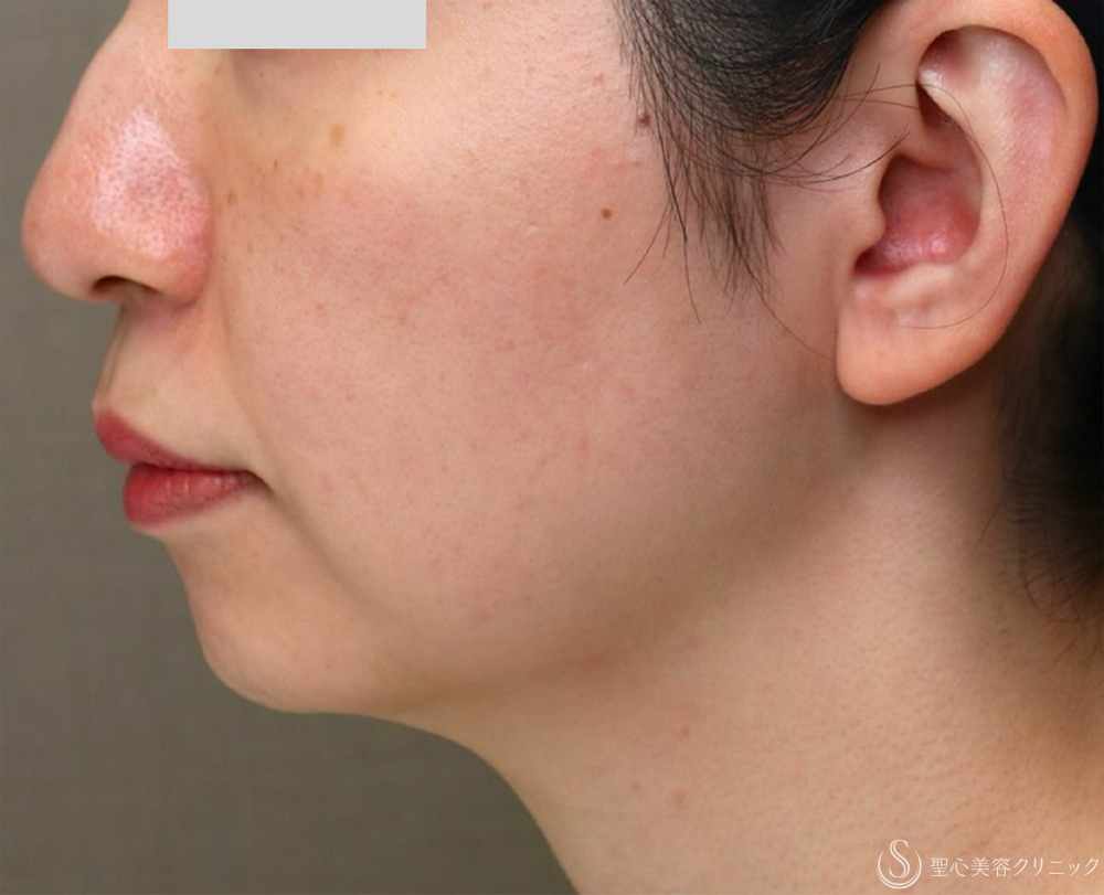 【30代女性・お顔の「筋トレ」でリフトアップ】【顔筋ケア】ワンダーフェイスプロ（3回施術直後） Before 