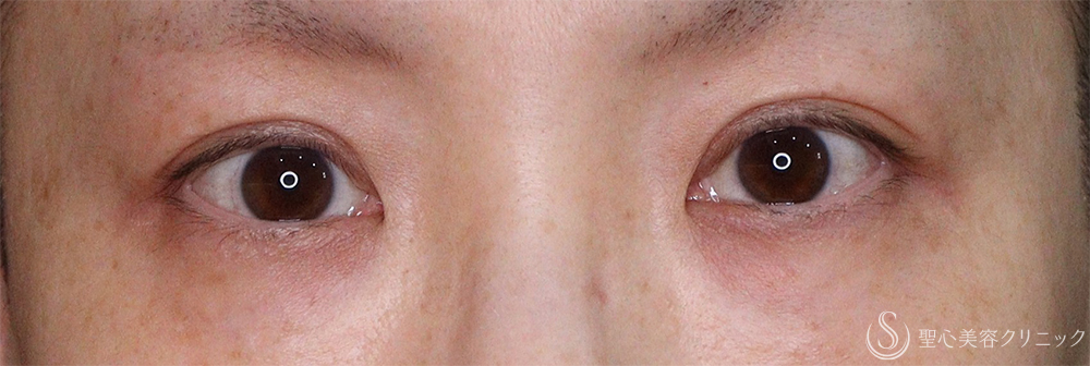 【40代女性・自然な二重に】 二重術（埋没法）：マイクロメソッド+α（直後、1ヶ月後、3ヶ月後） After 