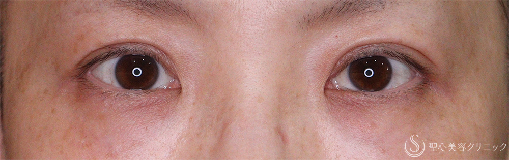 【40代女性・自然な二重に】 二重術（埋没法）：マイクロメソッド+α（直後、1ヶ月後、3ヶ月後） After 