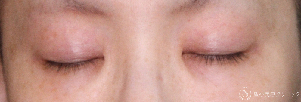 【40代女性・自然な二重に】 二重術（埋没法）：マイクロメソッド+α（直後、1ヶ月後、3ヶ月後） After 