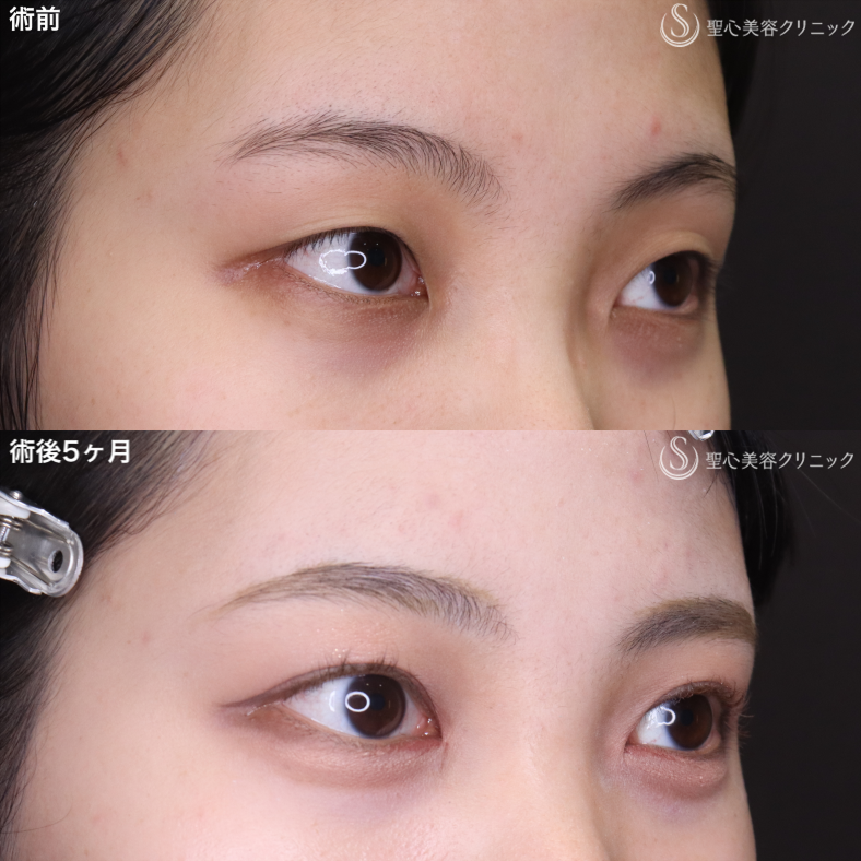 【20代女性・もともと二重であったかのようなナチュラルさに】二重術（切開法）＋目頭切開/目上切開 （5ヶ月後） After 