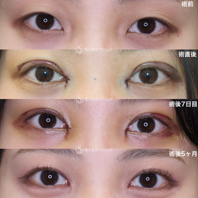 【20代女性・もともと二重であったかのようなナチュラルさに】二重術（切開法）＋目頭切開/目上切開 （5ヶ月後） After 