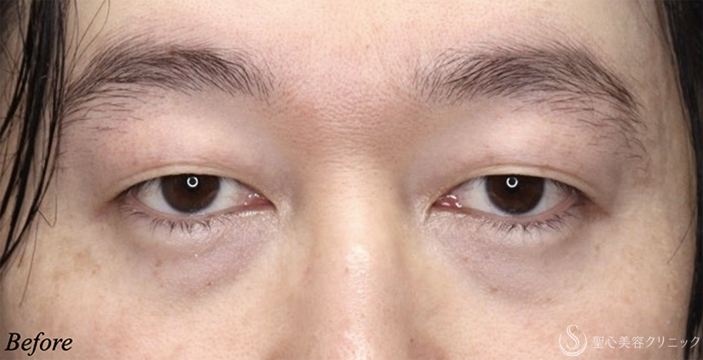 【30代男性・目の開きが改善】二重術（埋没法）：マイクロメソッド+α（1ヶ月後） Before 