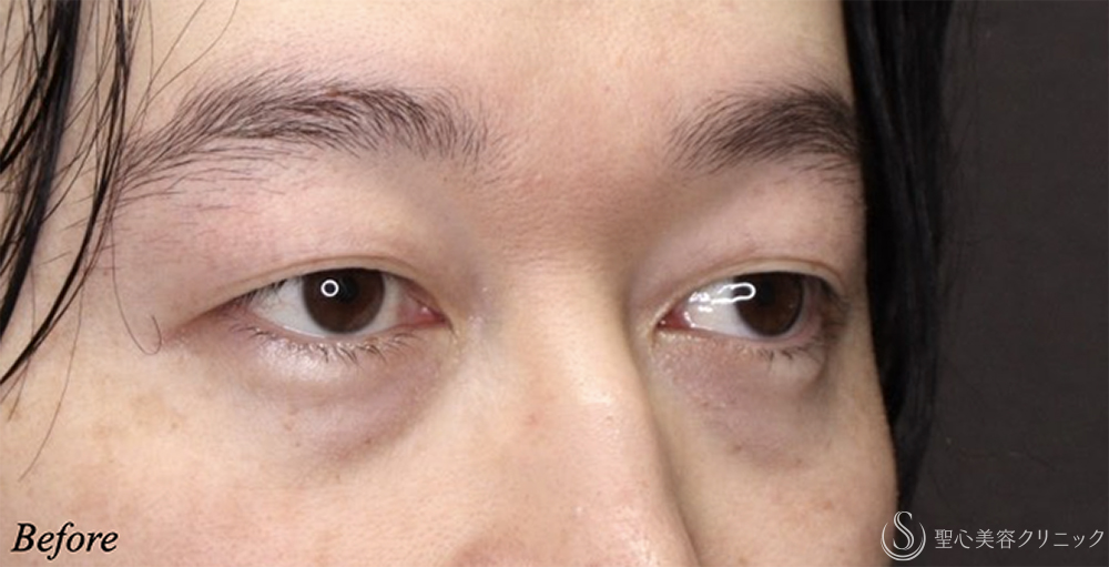 【30代男性・目の開きが改善】二重術（埋没法）：マイクロメソッド+α（1ヶ月後） Before 