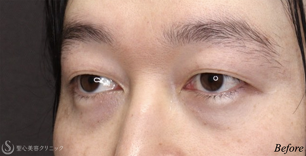 【30代男性・目の開きが改善】二重術（埋没法）：マイクロメソッド+α（1ヶ月後） Before 