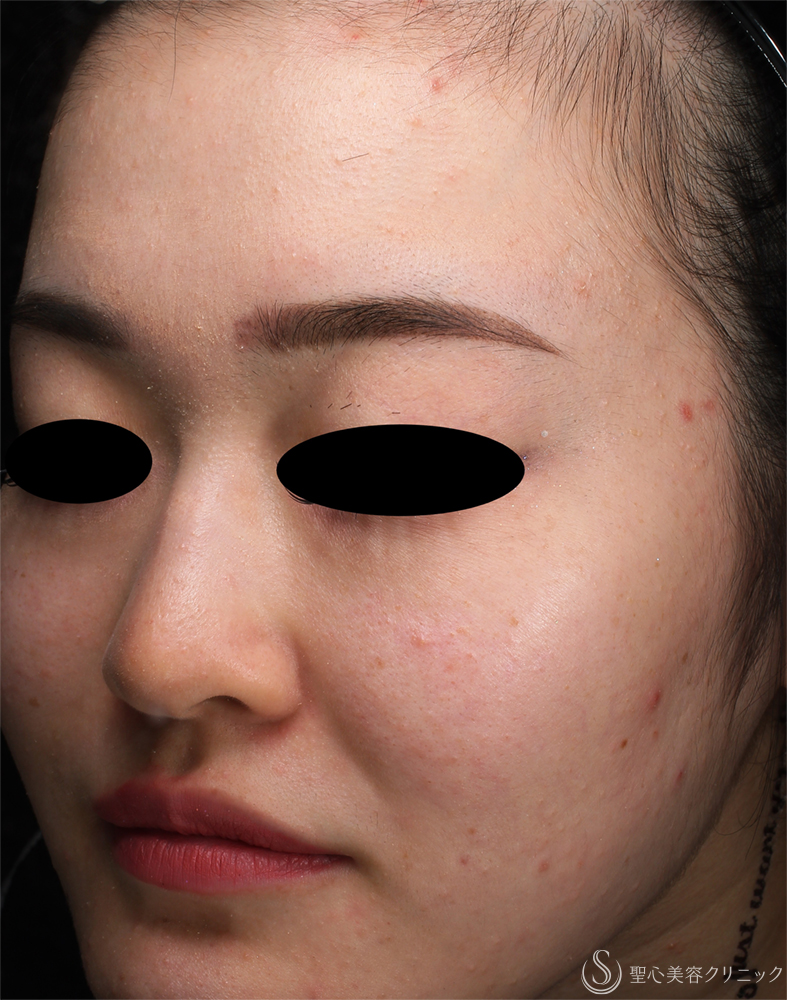 【20代女性・肌のざらつき】ダーマペン_ニキビ跡（1ヶ月後） Before 