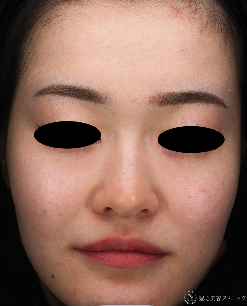 【20代女性・肌のざらつき】ダーマペン_ニキビ跡（1ヶ月後） Before 