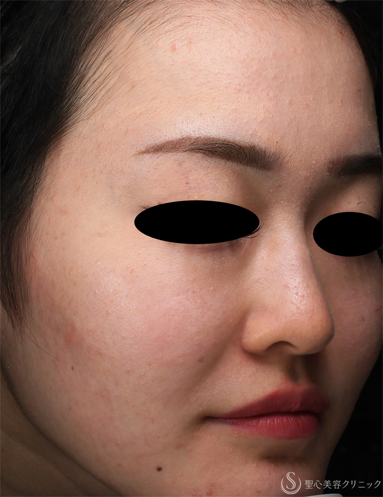【20代女性・肌のざらつき】ダーマペン_ニキビ跡（1ヶ月後） Before 