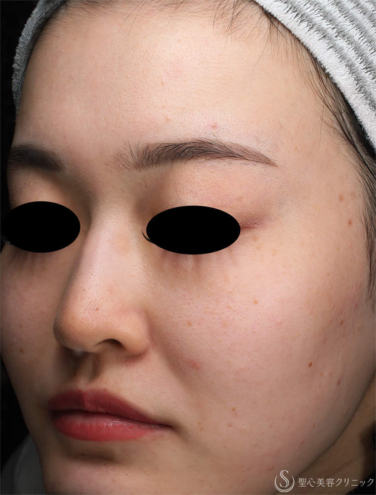【20代女性・肌のざらつき】ダーマペン_ニキビ跡（1ヶ月後） After 