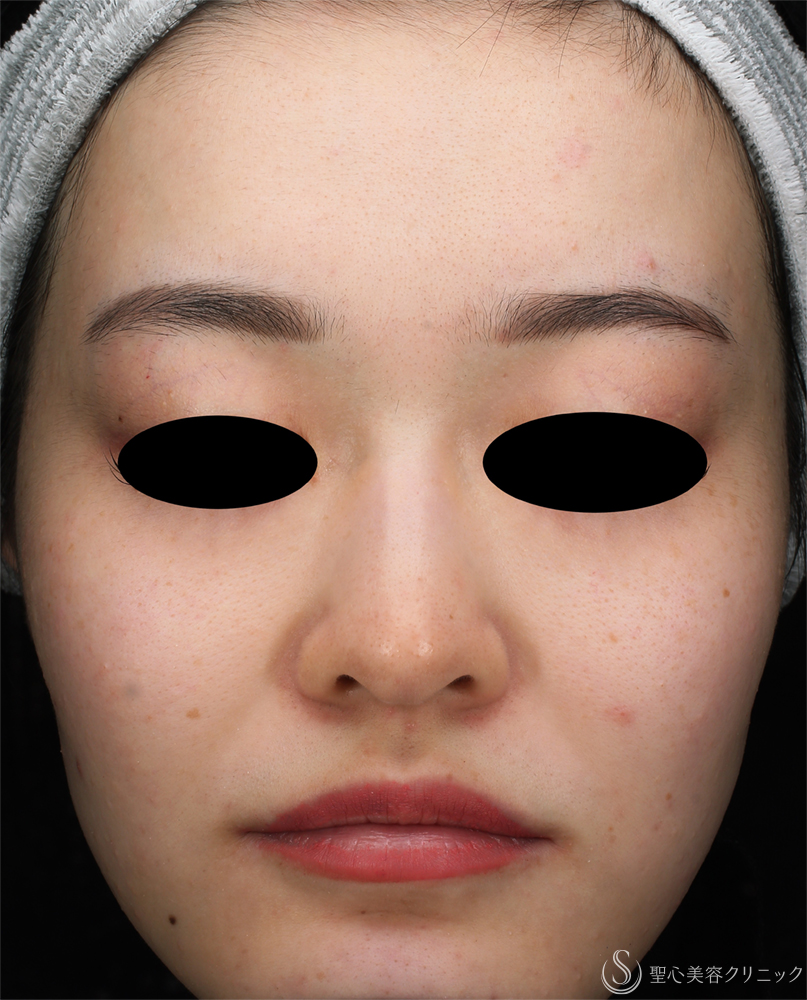 【20代女性・肌のざらつき】ダーマペン_ニキビ跡（1ヶ月後） After 