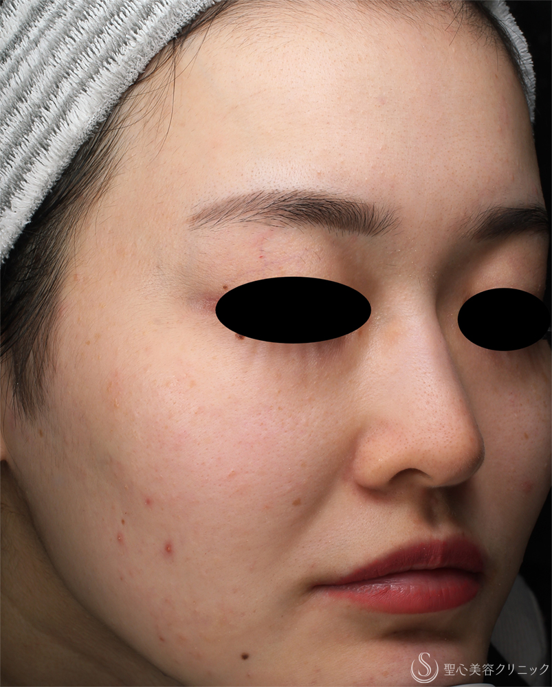 【20代女性・肌のざらつき】ダーマペン_ニキビ跡（1ヶ月後） After 