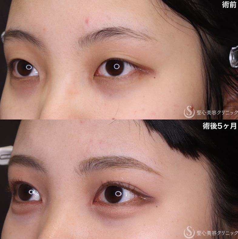 【20代女性・もともと二重であったかのようなナチュラルさに】二重術（切開法）＋目頭切開/目上切開 （5ヶ月後） After 