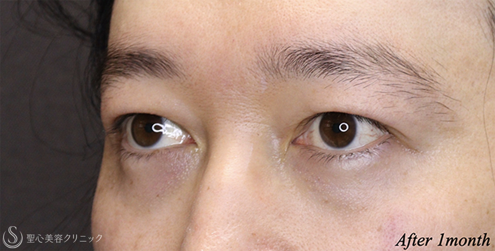 【30代男性・目の開きが改善】二重術（埋没法）：マイクロメソッド+α（1ヶ月後） After 