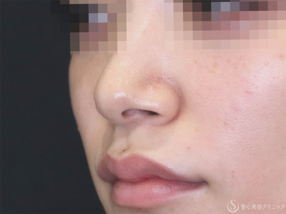 【20代女性・より自然により小さく】小鼻縮小（6日後） Before 