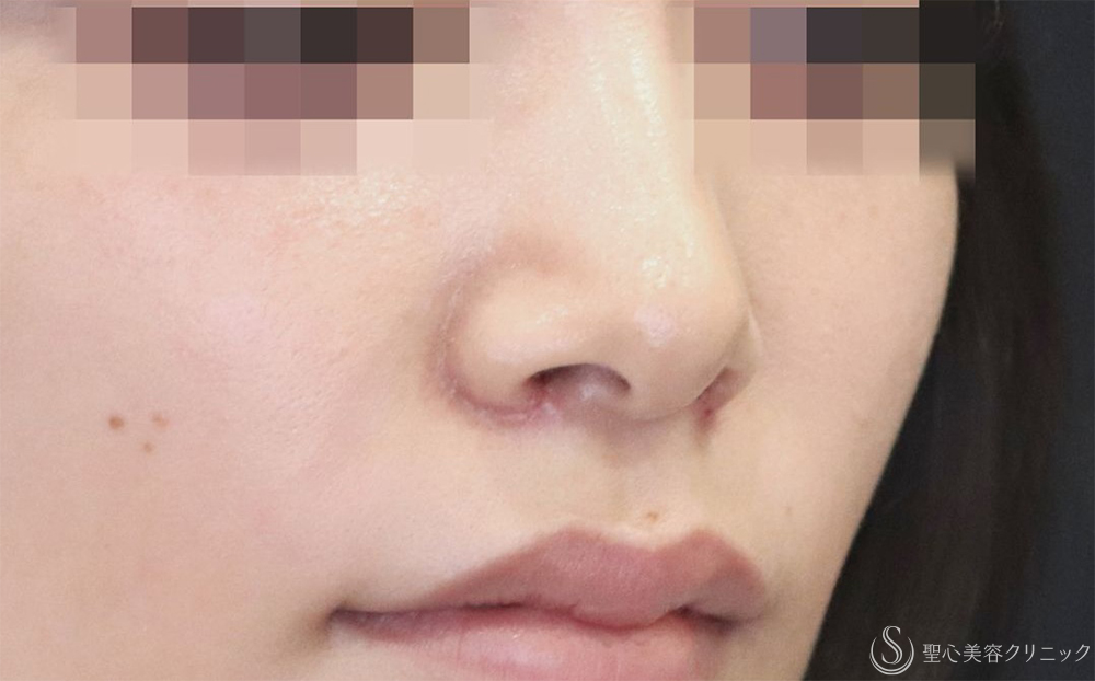【20代女性・より自然により小さく】小鼻縮小（6日後） After 