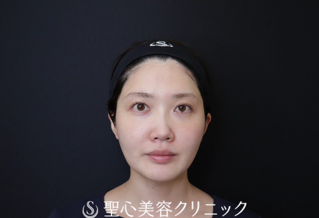 【30代女性・すっきりとした輪郭と、輝きを増す目もとへ】ドクターハイフ（ウルトラセル[zíː]）＋ドクターDENSITY（デンシティ）（直後） After 