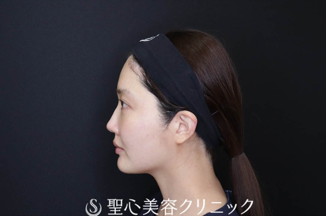 【30代女性・すっきりとした輪郭と、輝きを増す目もとへ】ドクターハイフ（ウルトラセル[zíː]）＋ドクターDENSITY（デンシティ）（直後） After 