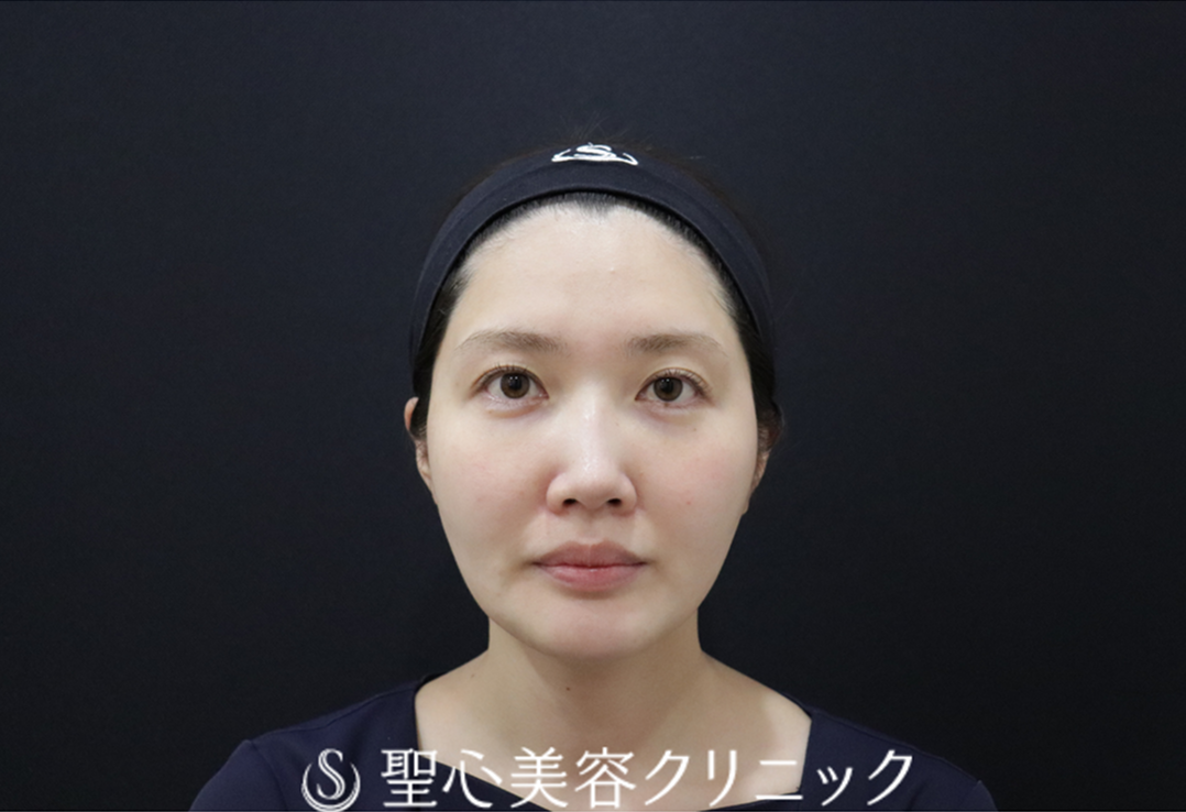 【30代女性・すっきりとした輪郭と、輝きを増す目もとへ】ドクターハイフ（ウルトラセル[zíː]）＋ドクターDENSITY（デンシティ）（直後） Before 