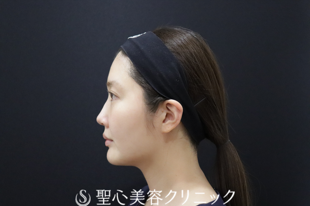 【30代女性・すっきりとした輪郭と、輝きを増す目もとへ】ドクターハイフ（ウルトラセル[zíː]）＋ドクターDENSITY（デンシティ）（直後） Before 