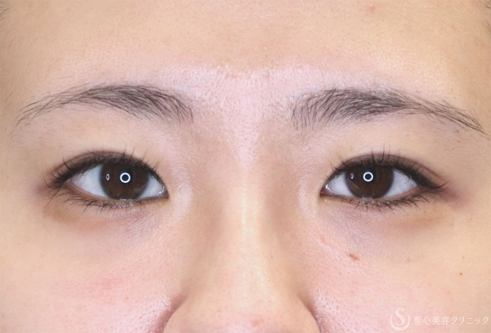 【20代女性・自然な二重に】目頭切開/目上切開（6日後） Before 