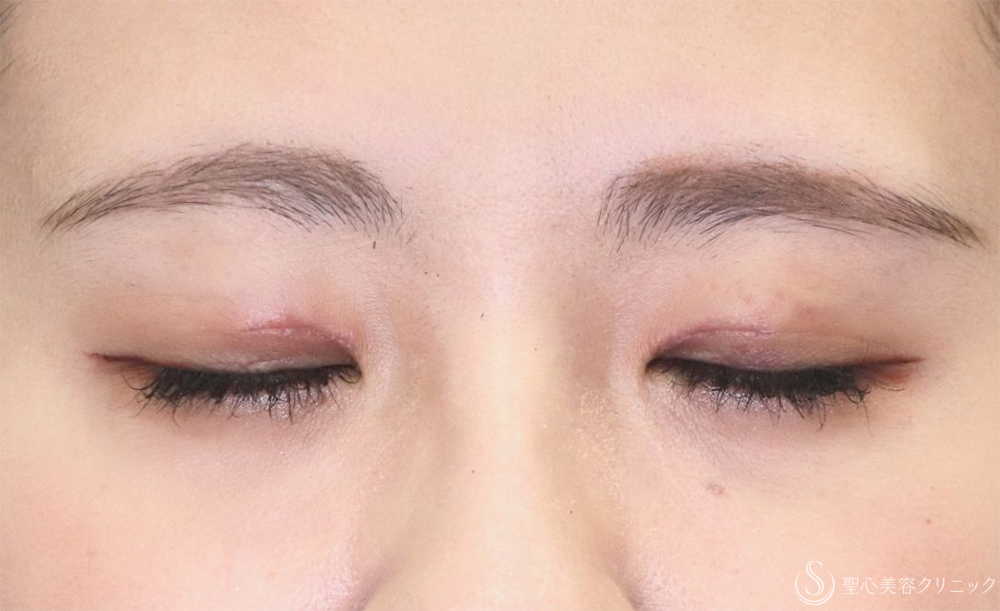 【20代女性・自然な二重に】目頭切開/目上切開（6日後） After 