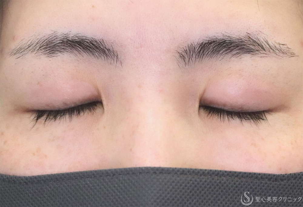 【20代女性・綺麗な末広型に】二重術（埋没法）：マイクロメソッド+α（2ヶ月後） Before 