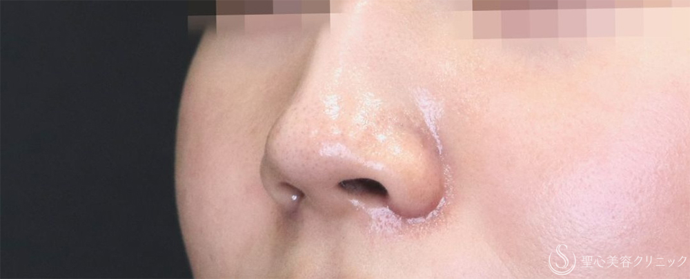【20代女性・小鼻を小さく】小鼻縮小（1ヶ月後） After 