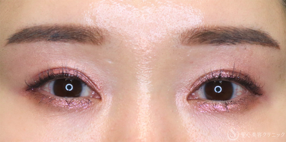 【30代女性・スッキリとした平行二重に】眉下切開法（眉下リフト）＋ 二重術（埋没法）：マイクロメソッド+α（3ヶ月後・1年6ヶ月後） After 名古屋・平行二重