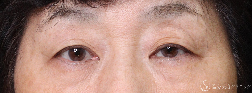 【60代女性・目の上のたるみ】眉下切開法（眉下リフト）（1ヶ月後） Before 