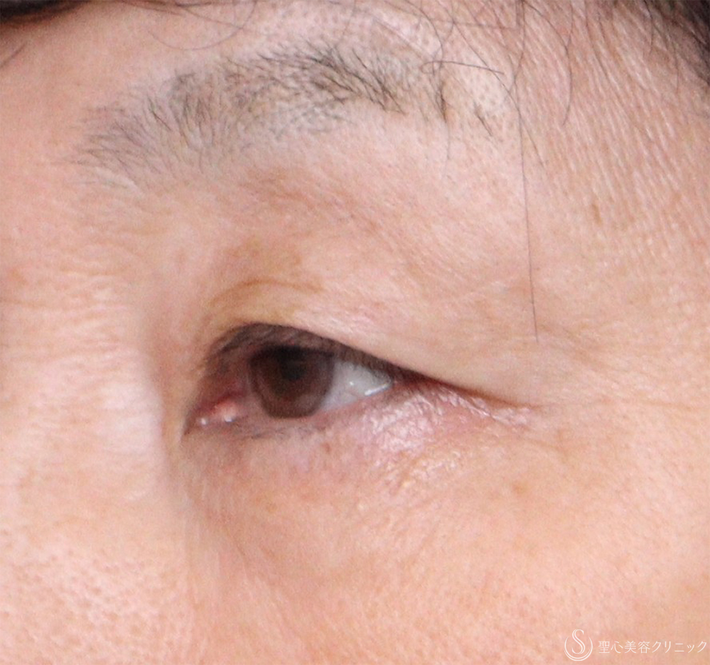 【60代女性・目の上のたるみ】眉下切開法（眉下リフト）（1ヶ月後） Before 