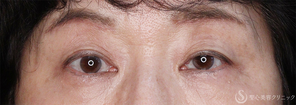 【60代女性・目の上のたるみ】眉下切開法（眉下リフト）（1ヶ月後） After 