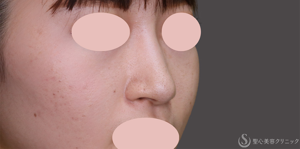 【20代女性・鼻先を出して横顔を整える】鼻尖縮小＋鼻尖形成（耳介軟骨移植）（1ヶ月後） After 