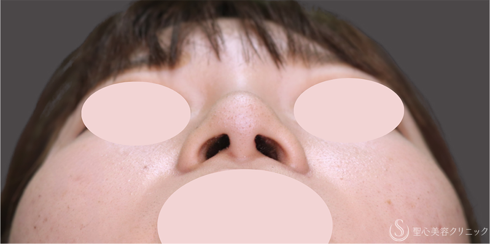 【20代女性・鼻先を出して横顔を整える】鼻尖縮小＋鼻尖形成（耳介軟骨移植）（1ヶ月後） After 