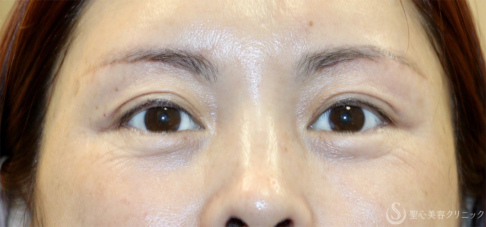 【40代女性・目の上のたるみ処置】眉下切開法（眉下リフト）_若返り（1ヶ月後） After 