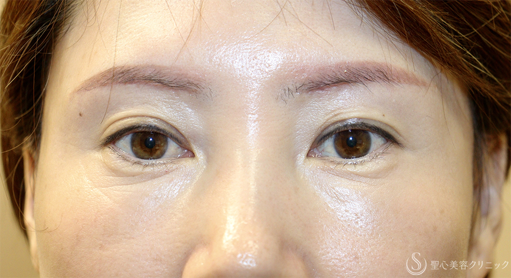 【40代女性・目の上のたるみ処置】眉下切開法（眉下リフト）_若返り（1ヶ月後） After 