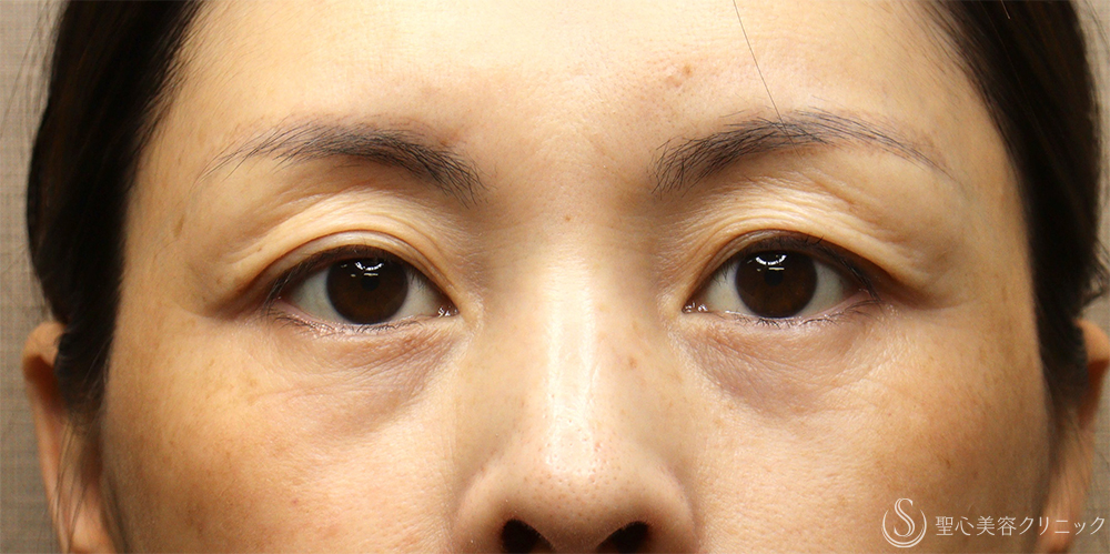 【40代女性・目の上のたるみ処置】眉下切開法（眉下リフト）_若返り（1ヶ月後） Before 