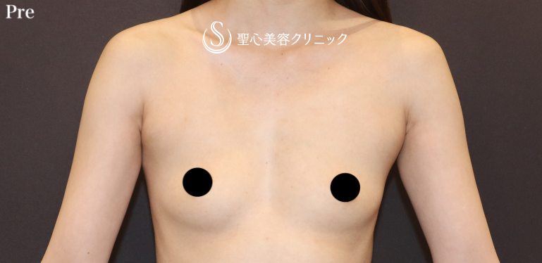 【20代女性・長年のコンプレックスを解消する】バッグプロテーゼ挿入（モディバエルゴノミクス2/Mini200cc）（1ヶ月後） Before 