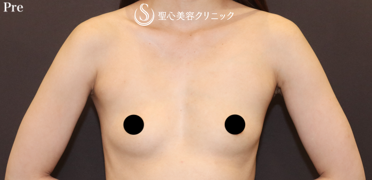 【20代女性・長年のコンプレックスを解消する】バッグプロテーゼ挿入（モディバエルゴノミクス2/Mini200cc）（1ヶ月後） Before 