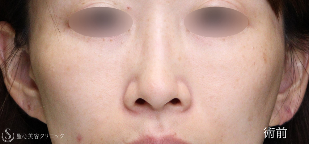 【30代女性・鼻尖縮小と小鼻縮小で忘れ鼻に】 鼻尖縮小＋ 小鼻縮小（1ヶ月後） Before 