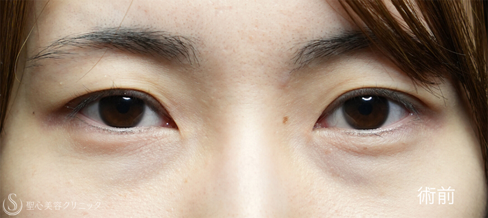 【20代女性・裏ハムラと二重埋没法で目元のナチュラルアップデート】下眼瞼切開術/下眼瞼除皺術/ハムラ法＋ 二重術（埋没法）：マイクロメソッド+α（1ヶ月後～1年後） Before 