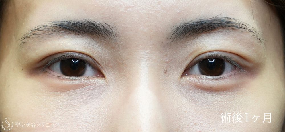 【20代女性・裏ハムラと二重埋没法で目元のナチュラルアップデート】下眼瞼切開術/下眼瞼除皺術/ハムラ法＋ 二重術（埋没法）：マイクロメソッド+α（1ヶ月後～1年後） After 