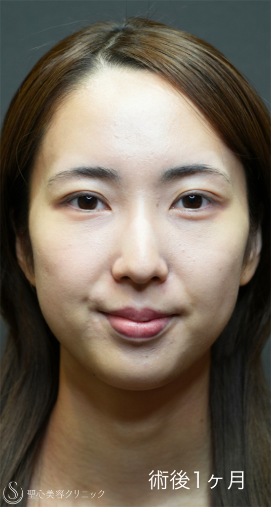 【20代女性・裏ハムラと二重埋没法で目元のナチュラルアップデート】下眼瞼切開術/下眼瞼除皺術/ハムラ法＋ 二重術（埋没法）：マイクロメソッド+α（1ヶ月後～1年後） After 