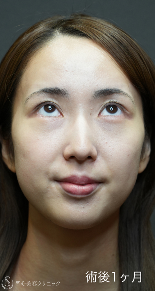 【20代女性・裏ハムラと二重埋没法で目元のナチュラルアップデート】下眼瞼切開術/下眼瞼除皺術/ハムラ法＋ 二重術（埋没法）：マイクロメソッド+α（1ヶ月後～1年後） After 