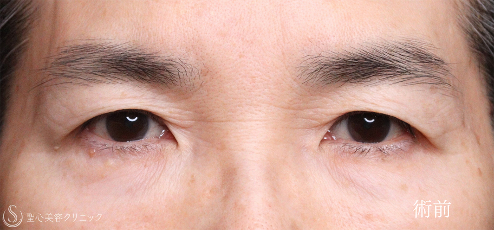 【60代女性・お目元のアンチエイジング施術でスッキリ瞼（まぶた）に】 眉下切開法（眉下リフト）＋ 目上切開（術後1ヶ月～3ヶ月） Before 