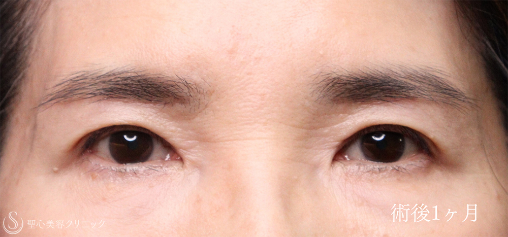 【60代女性・お目元のアンチエイジング施術でスッキリ瞼（まぶた）に】 眉下切開法（眉下リフト）＋ 目上切開（術後1ヶ月～3ヶ月） After 