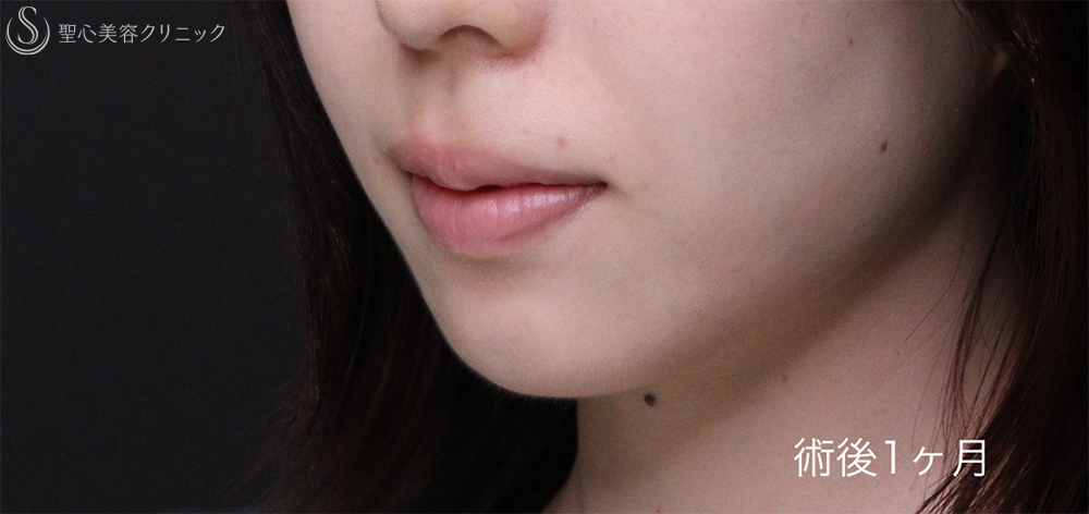 【20代女性・唇を薄くして上品な印象に】口唇縮小術（術後1週間～3ヶ月） After 