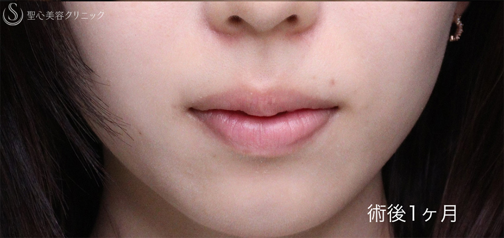 【20代女性・唇を薄くして上品な印象に】口唇縮小術（術後1週間～3ヶ月） After 