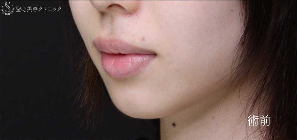 【20代女性・唇を薄くして上品な印象に】口唇縮小術（術後1週間～3ヶ月） Before 