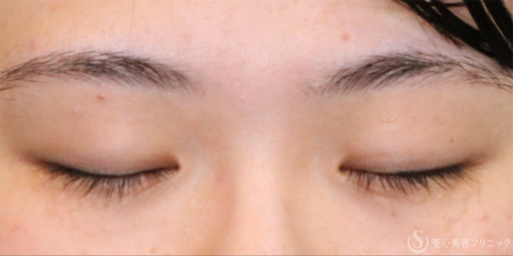 【20代女性・左右差を整える】二重埋没法（マイクロメソッド+α）（1ヶ月後） Before 